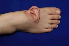 প্রথমবারের মতো বিচ্ছিন্ন কান পায়ে প্রতিস্থাপন, আবার যথাস্থানে স্থাপন