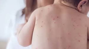 গত ২৪ ঘন্টায় হামের উপসর্গ নিয়ে ৪ শিশুর মৃত্যু